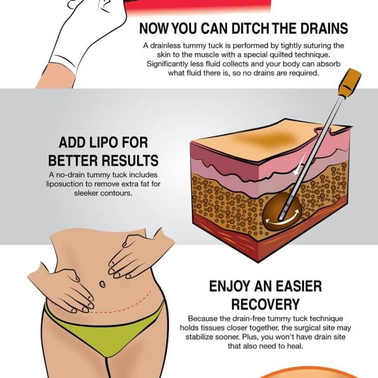 Tummy Tuck